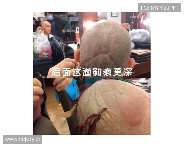 字母哥分享眼部淤青原因逛超市遭遇抢劫勇敢制服歹徒受伤